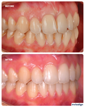 Dubai, Dental, Invisalign Treatment In Dubai