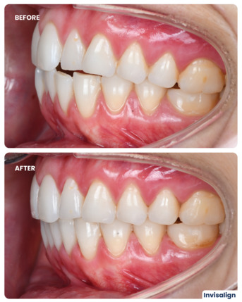 Dubai, Dental, Invisalign Treatment In Dubai