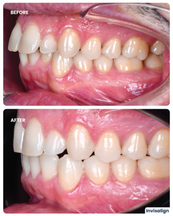 Dubai, Dental, Invisalign Treatment In Dubai