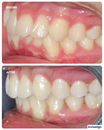 Dubai, Dental, Invisalign Treatment In Dubai