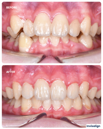 Dubai, Dental, Invisalign Treatment In Dubai