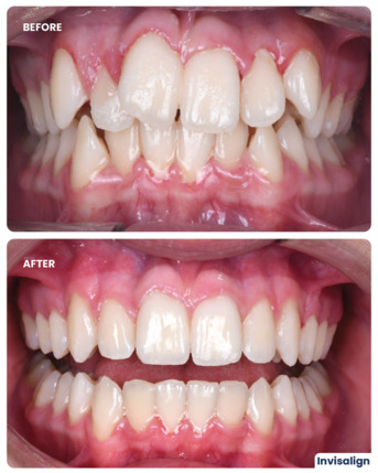 Dubai, Dental, Invisalign Treatment In Dubai