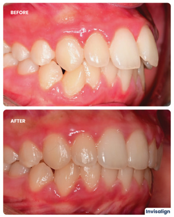 Dubai, Dental, Invisalign Treatment In Dubai