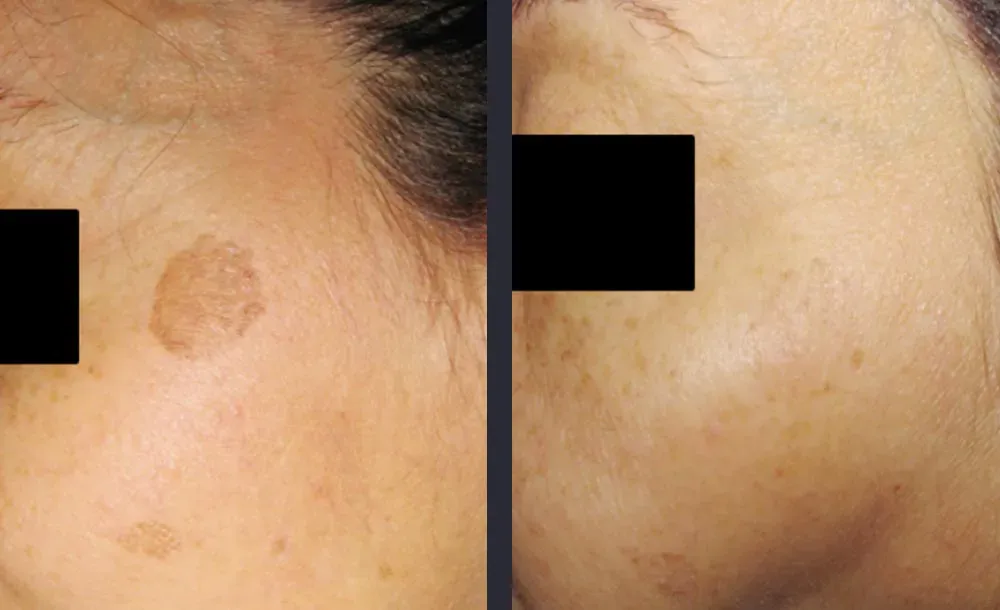 New York, Business, Best Treatment For Melasma For Clear Even Skin