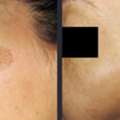 Best Treatment For Melasma For Clear Even Skin