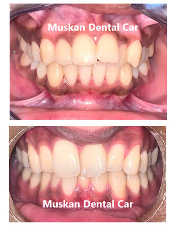 New Delhi, Health, Best Root Canal Treatment In Delhi NCR