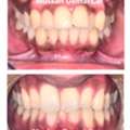 Best Root Canal Treatment In Delhi NCR