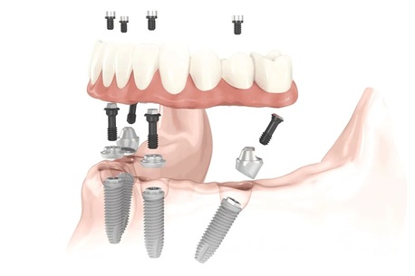 San Diego, Health, Affordable Dentures