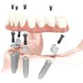 Affordable Dentures