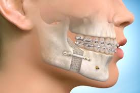 Mumbai, Dental, Jaw Correction Without Surgery &ndash; Safe & Effective Care
