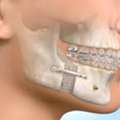 Jaw Correction Without Surgery &ndash; Safe & Effective Care