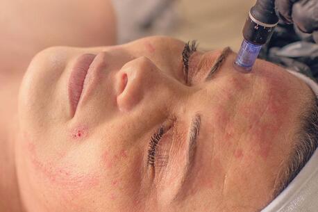 Surrey, Beautician, Microneedling Surrey For Acne Scars & Glowing Skin | Book Now
