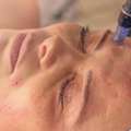 Microneedling Surrey For Acne Scars & Glowing Skin | Book Now