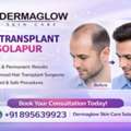 Painless Hair Transplant In Solapur With Natural Results