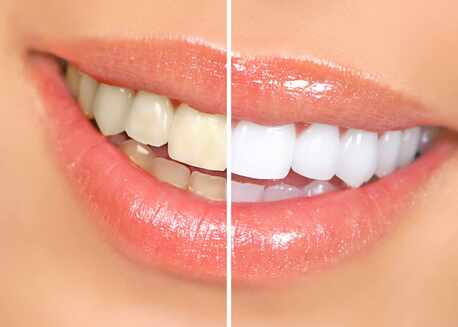 New Delhi, Dental, Tooth Bleaching In Delhi NCR