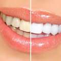 Tooth Bleaching In Delhi NCR