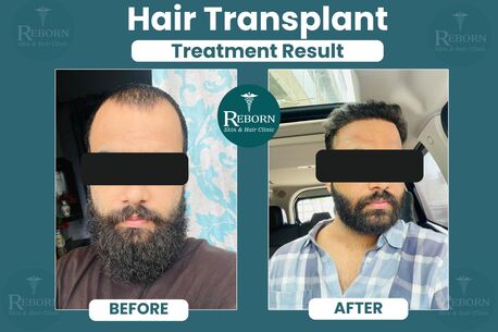 Jaipur, Health & Beauty Items, INR 29999,  Hair Transplant In Jaipur - Get Permanent Hair Loss Solutions