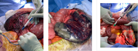 Ahmedabad, Health, Bowel Obstruction Treatment With Proper Medical Care