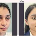 Eyelid Surgery In Delhi - Dr Rajat Gupta