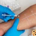 Scarless Reproductive & Pinhole Interventional Treatments &ndash; Dr Akash Clinic