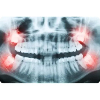 Melbourne, Dental, Wisdom Teeth Surgery Melbourne