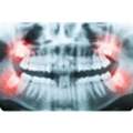Wisdom Teeth Surgery Melbourne