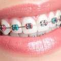 Braces Near Me