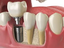 Noida, Dental, Teeth Implant Near Me