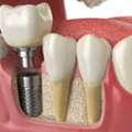 Teeth Implant Near Me