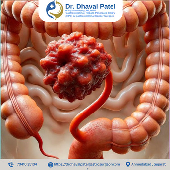 Ahmedabad, Health, Highly Experienced Colon Cancer Surgeon In Ahmedabad &ndash; Dr. Dhaval Patel