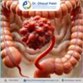 Highly Experienced Colon Cancer Surgeon In Ahmedabad &ndash; Dr. Dhaval Patel
