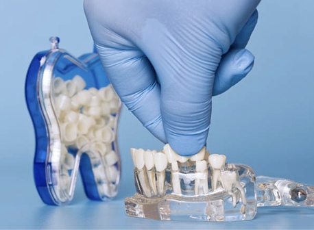 Auckland, Health, Dental Bridges In Mount Roskill, Auckland