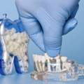 Dental Bridges In Mount Roskill, Auckland