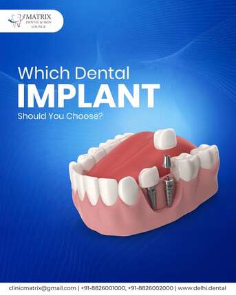 New Delhi, Help, Best Dental Implants In Delhi For A Confident Smile