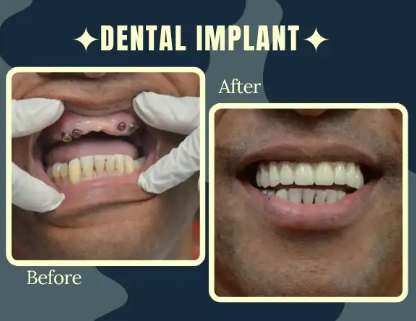 Gurgaon, Dental, Best Implantologist In Gurgaon For Safe & Permanent Tooth Replacement