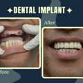 Best Implantologist In Gurgaon For Safe & Permanent Tooth Replacement