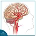 Advanced Aneurysm Coiling Treatment For Safe And Effective Care