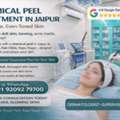 INR 2000,  Best Chemical Peel Treatment In Jaipur Near JLN Marg