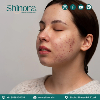 Ahmedabad, Health, Reveal Clear & Smooth Skin With Acne Scar Treatment In Ahmedabad &ndash; Shinora Clinic