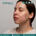 Reveal Clear & Smooth Skin With Acne Scar Treatment In Ahmedabad &ndash; Shinora Clinic