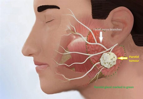 Jaipur, Health, Head & Neck Cancer Surgeon In Raja Park Jaipur