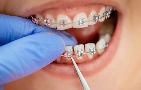 Al Ain, Dental, Premium Orthodontic Braces In Al Ain