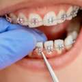 Premium Orthodontic Braces In Al Ain