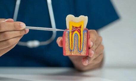 Al Ain, Dental, Advanced Root Canal Treatment In Al Ain