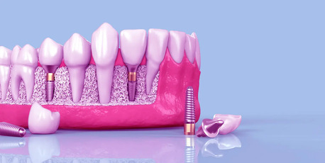 New Delhi, Health, Dental Implants In Dwarka | Dental Implant Treatment Dwarka