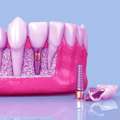 Dental Implants In Dwarka | Dental Implant Treatment Dwarka