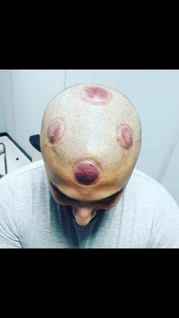 Riyadh, Health & Beauty Items, Hijama Cupping Therapy Riyadh Home Service