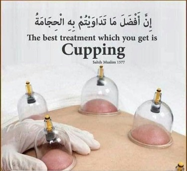 Riyadh, Health & Beauty Items, Hijama Cupping Therapy Riyadh Home Service