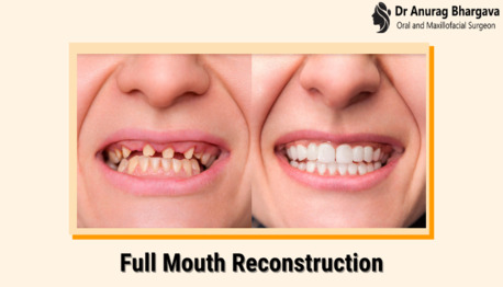 Indore, Health, Best Full Mouth Rehabilitation For Lasting Results | Dr. Anurag Bhargava