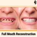 Best Full Mouth Rehabilitation For Lasting Results | Dr. Anurag Bhargava